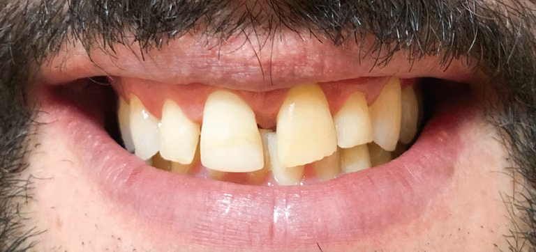 Lentes em resina composta – foto 1