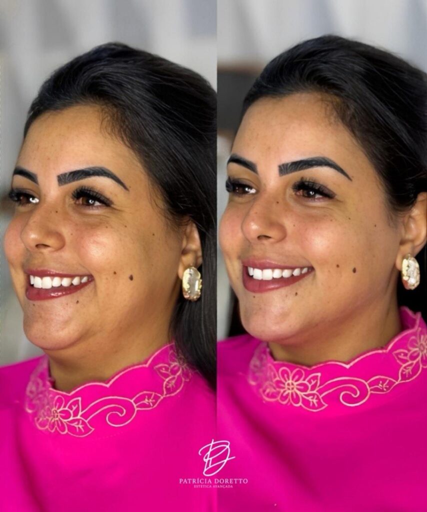 Onde o Básico Encontra Espaço: Botox e Preenchimento Dentro de um Planejamento Facial Estratégico