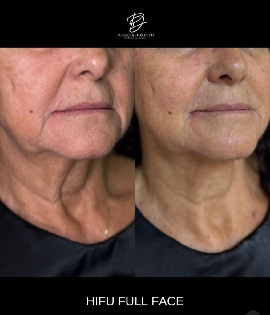 Onde o Básico Encontra Espaço: Botox e Preenchimento Dentro de um Planejamento Facial Estratégico — foto 2